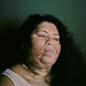 Angela, photographed on film for a personal project on Vitiligo
