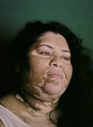 Angela, photographed on film for a personal project on Vitiligo